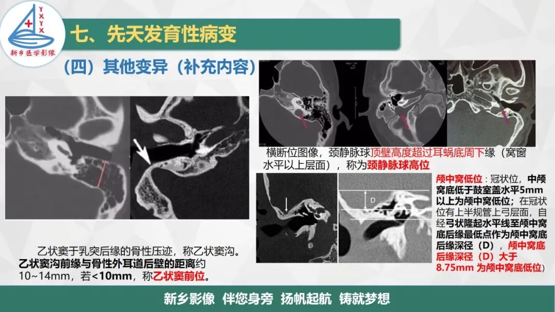 影像PPT - 【PPT】医学影像诊断学教材解读—耳部疾病2-23