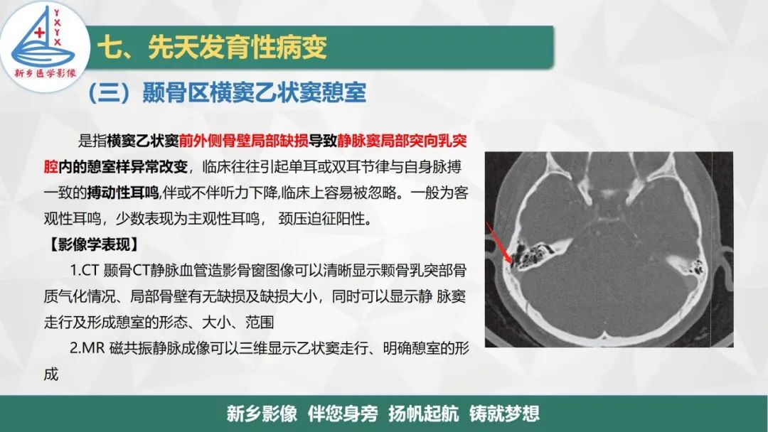 影像PPT - 【PPT】医学影像诊断学教材解读—耳部疾病2-22