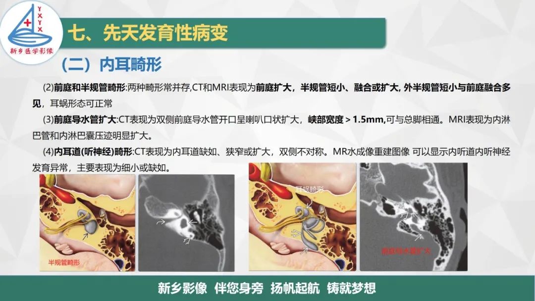 影像PPT - 【PPT】医学影像诊断学教材解读—耳部疾病2-21