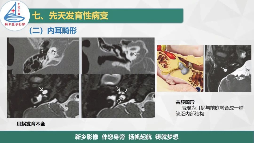 影像PPT - 【PPT】医学影像诊断学教材解读—耳部疾病2-20