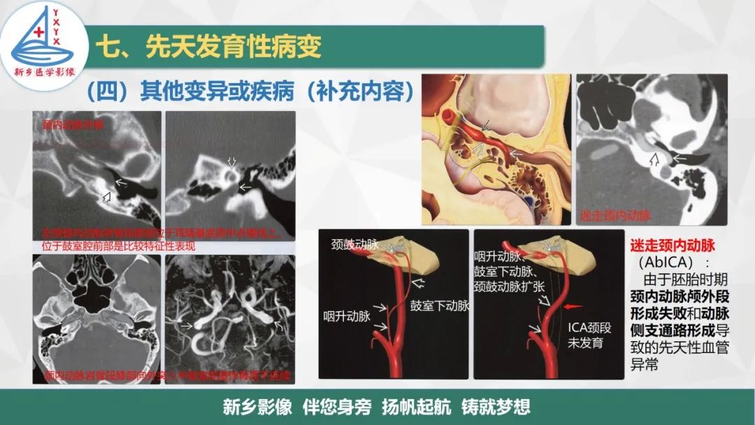影像PPT - 【PPT】医学影像诊断学教材解读—耳部疾病2-24