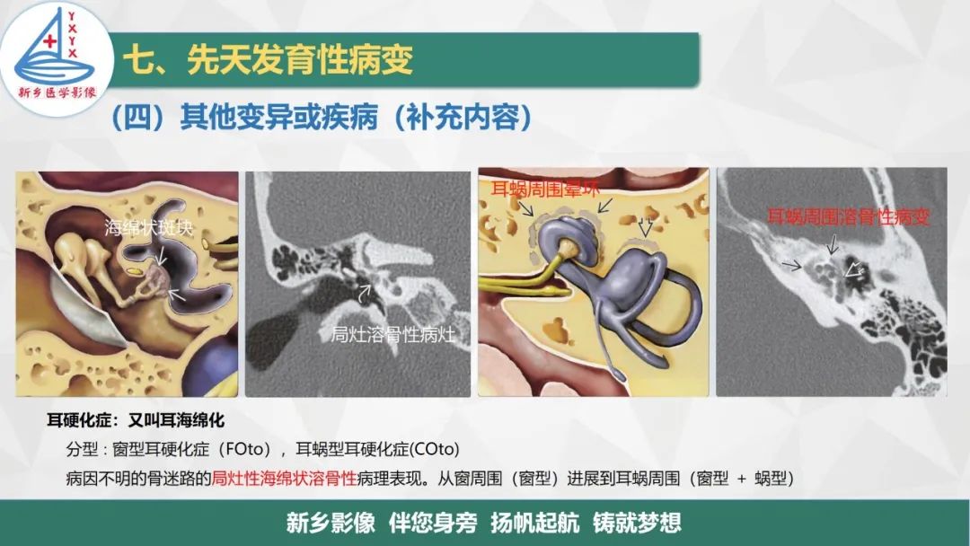 影像PPT - 【PPT】医学影像诊断学教材解读—耳部疾病2-25