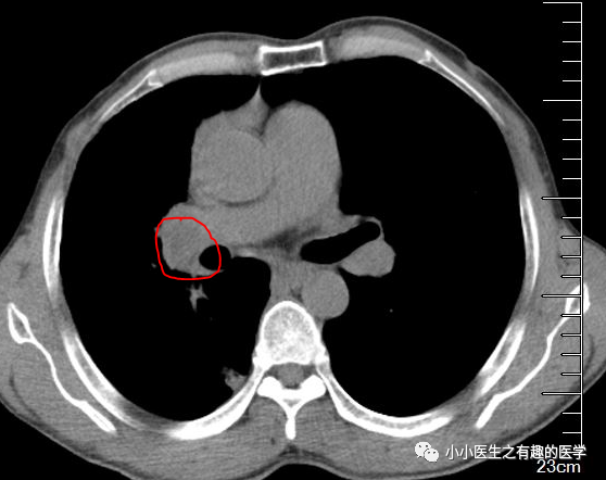 影像PPT - CT平扫诊断肺栓塞,国内外高手的总结-3 影像PPT - CT平扫诊断肺栓塞,国内外高手的总结-3