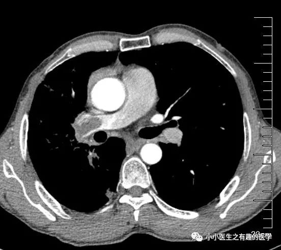 影像PPT - CT平扫诊断肺栓塞,国内外高手的总结-4 影像PPT - CT平扫诊断肺栓塞,国内外高手的总结-4
