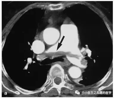 影像PPT - CT平扫诊断肺栓塞,国内外高手的总结-6 影像PPT - CT平扫诊断肺栓塞,国内外高手的总结-6