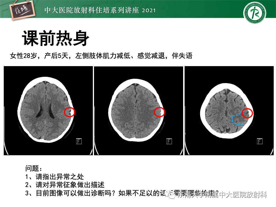 影像PPT - 【PPT】静脉性脑梗死的诊断思路-1