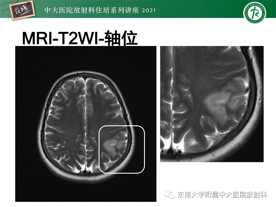 影像PPT - 【PPT】静脉性脑梗死的诊断思路-4