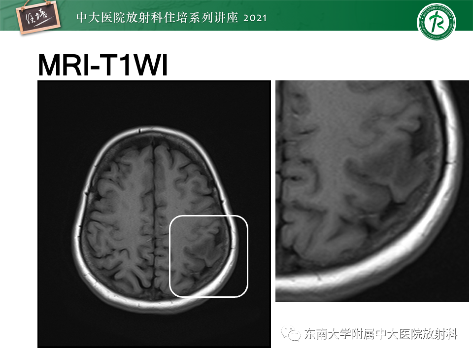 影像PPT - 【PPT】静脉性脑梗死的诊断思路-3