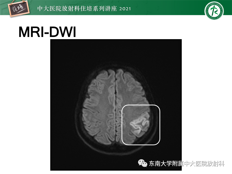 影像PPT - 【PPT】静脉性脑梗死的诊断思路-6