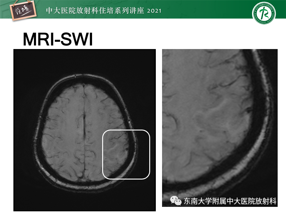 影像PPT - 【PPT】静脉性脑梗死的诊断思路-5