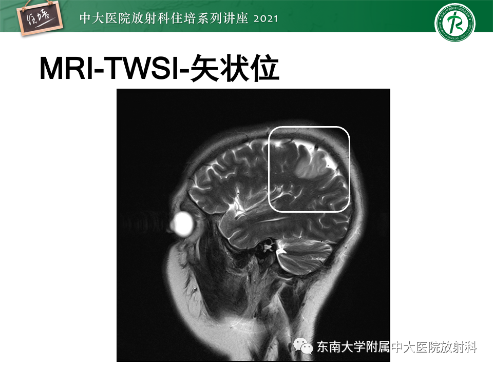 影像PPT - 【PPT】静脉性脑梗死的诊断思路-9
