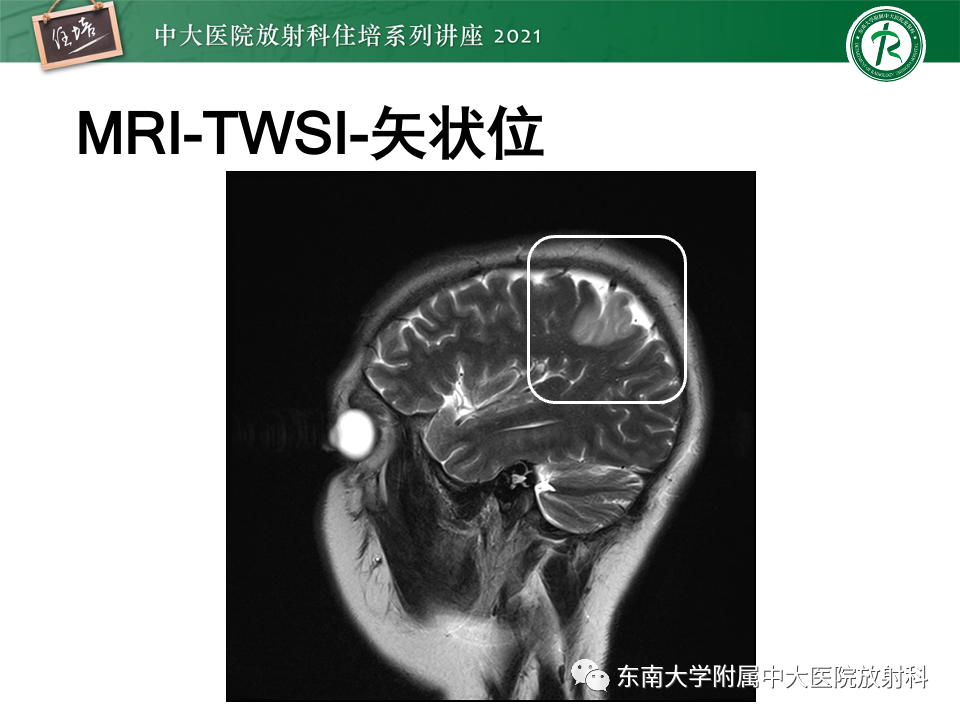 影像PPT - 【PPT】静脉性脑梗死的诊断思路-10