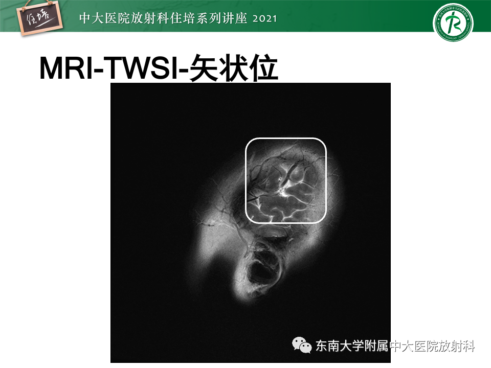 影像PPT - 【PPT】静脉性脑梗死的诊断思路-11