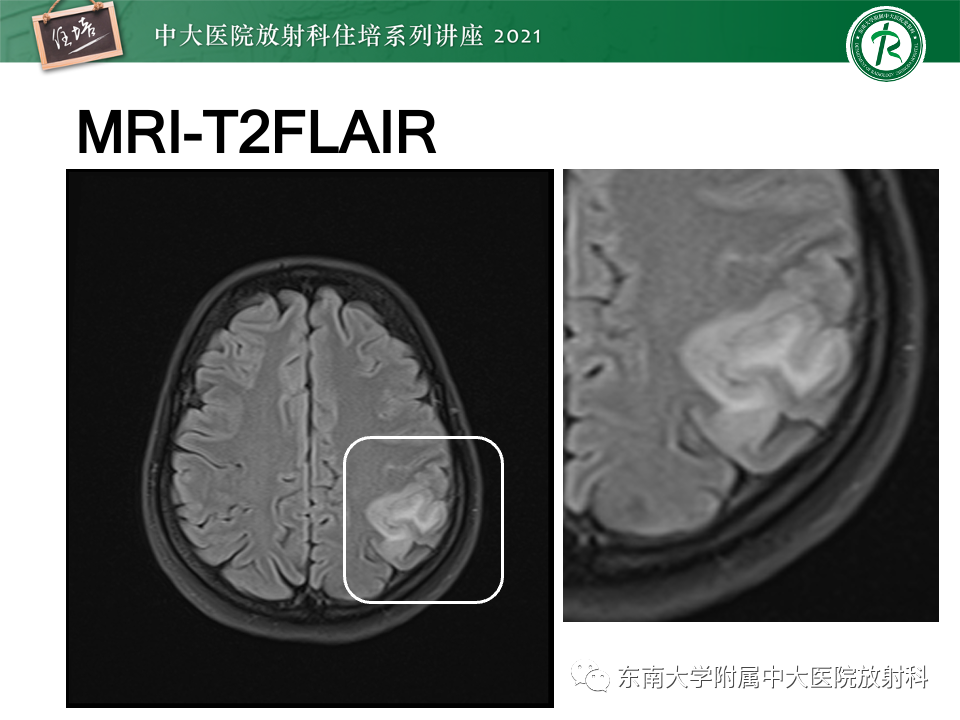 影像PPT - 【PPT】静脉性脑梗死的诊断思路-8