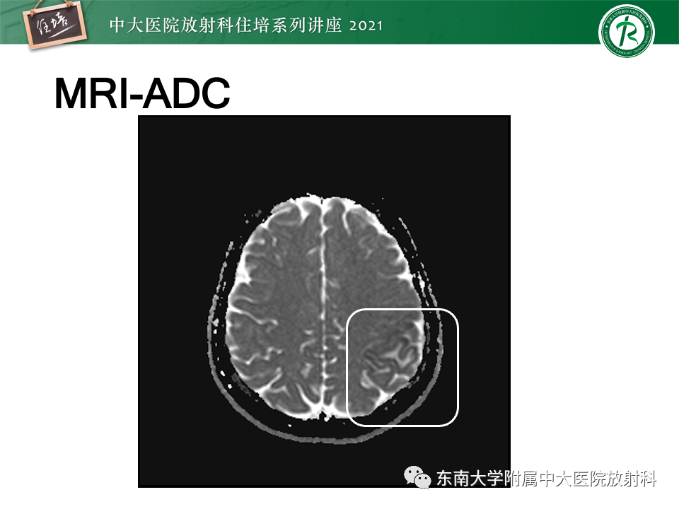 影像PPT - 【PPT】静脉性脑梗死的诊断思路-7