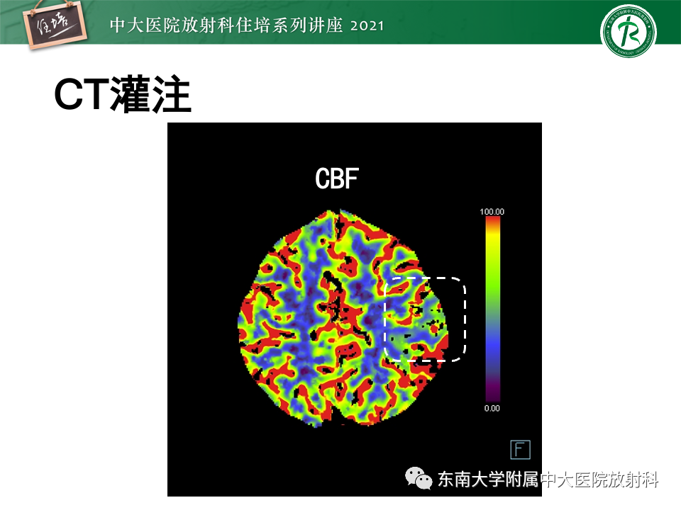 影像PPT - 【PPT】静脉性脑梗死的诊断思路-13