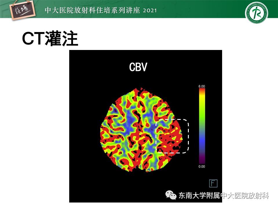 影像PPT - 【PPT】静脉性脑梗死的诊断思路-14