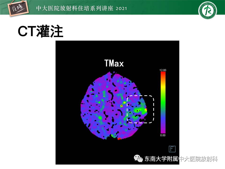 影像PPT - 【PPT】静脉性脑梗死的诊断思路-16