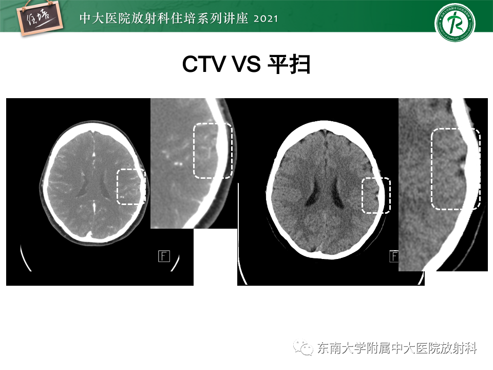 影像PPT - 【PPT】静脉性脑梗死的诊断思路-18