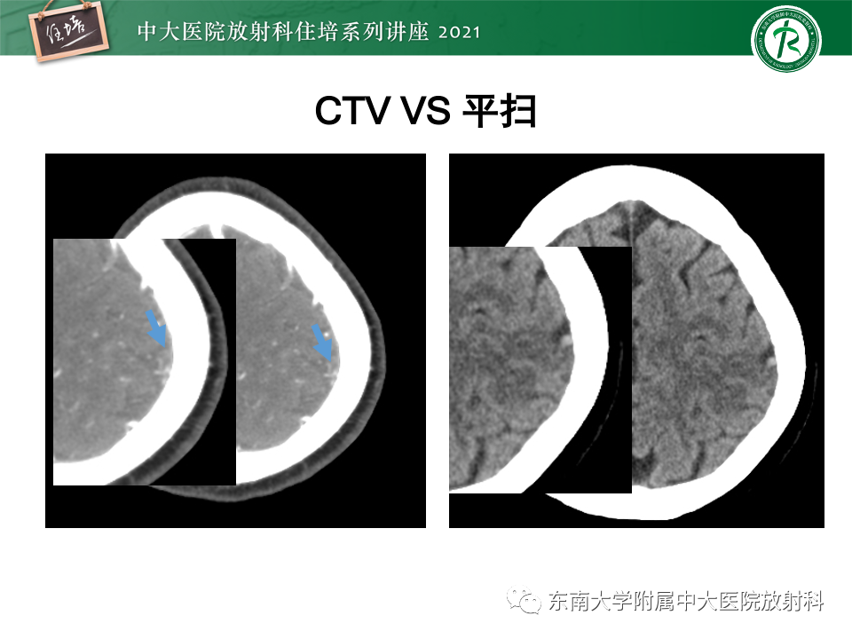 影像PPT - 【PPT】静脉性脑梗死的诊断思路-19