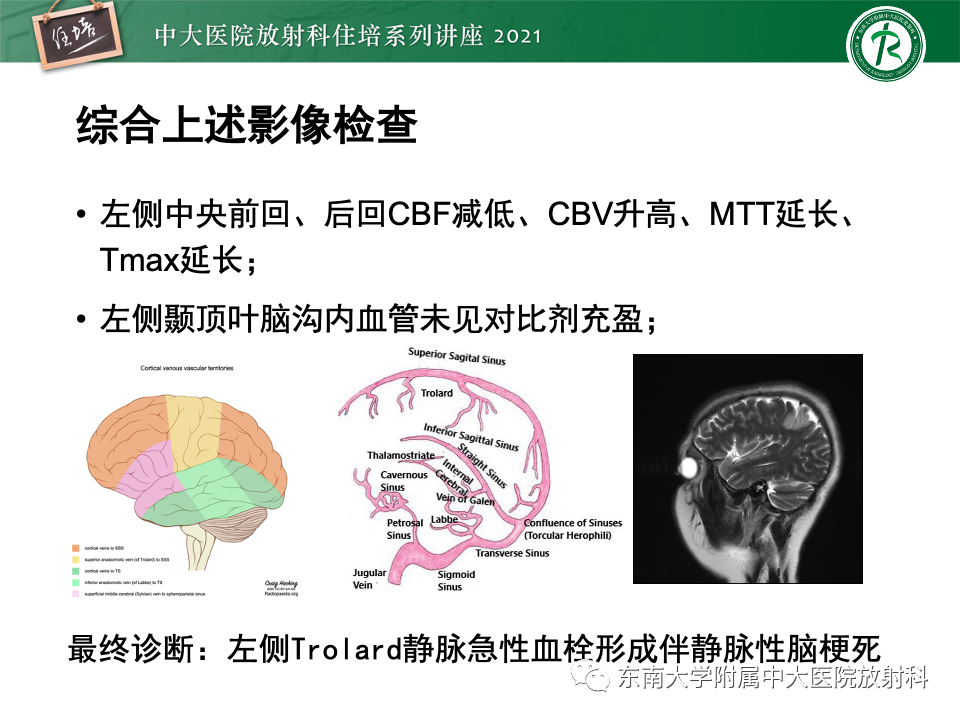 影像PPT - 【PPT】静脉性脑梗死的诊断思路-21