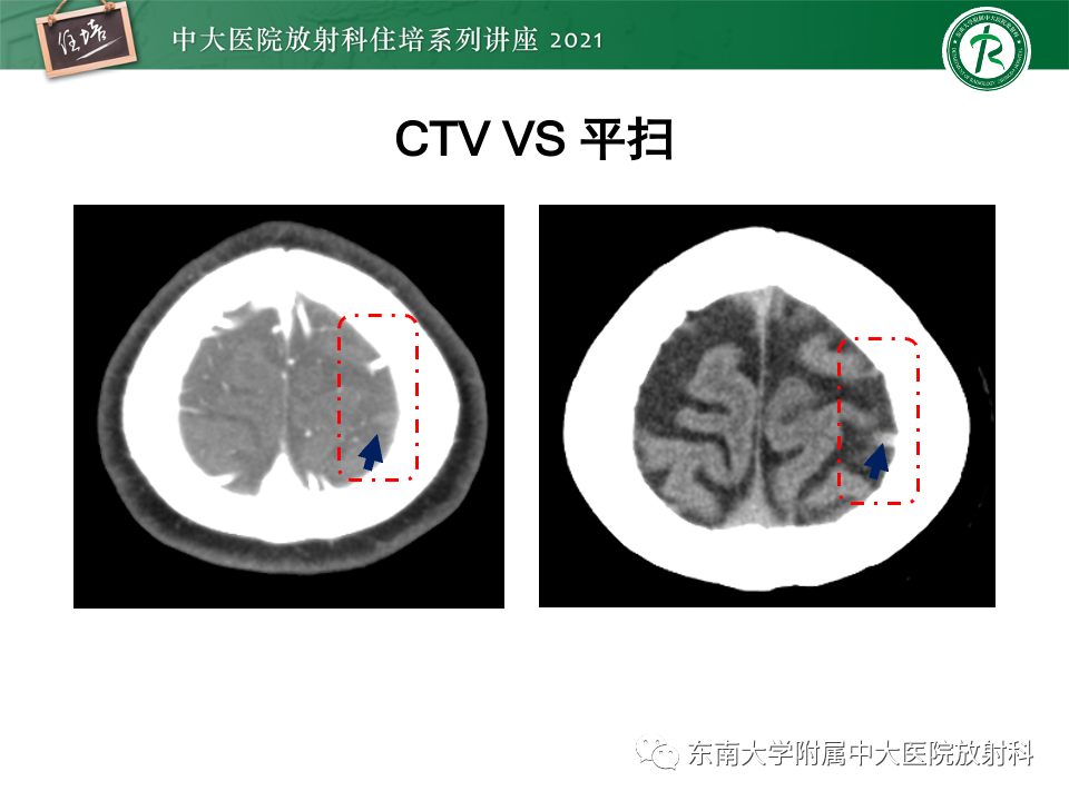 影像PPT - 【PPT】静脉性脑梗死的诊断思路-20