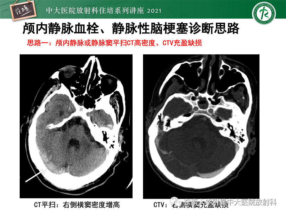 影像PPT - 【PPT】静脉性脑梗死的诊断思路-35