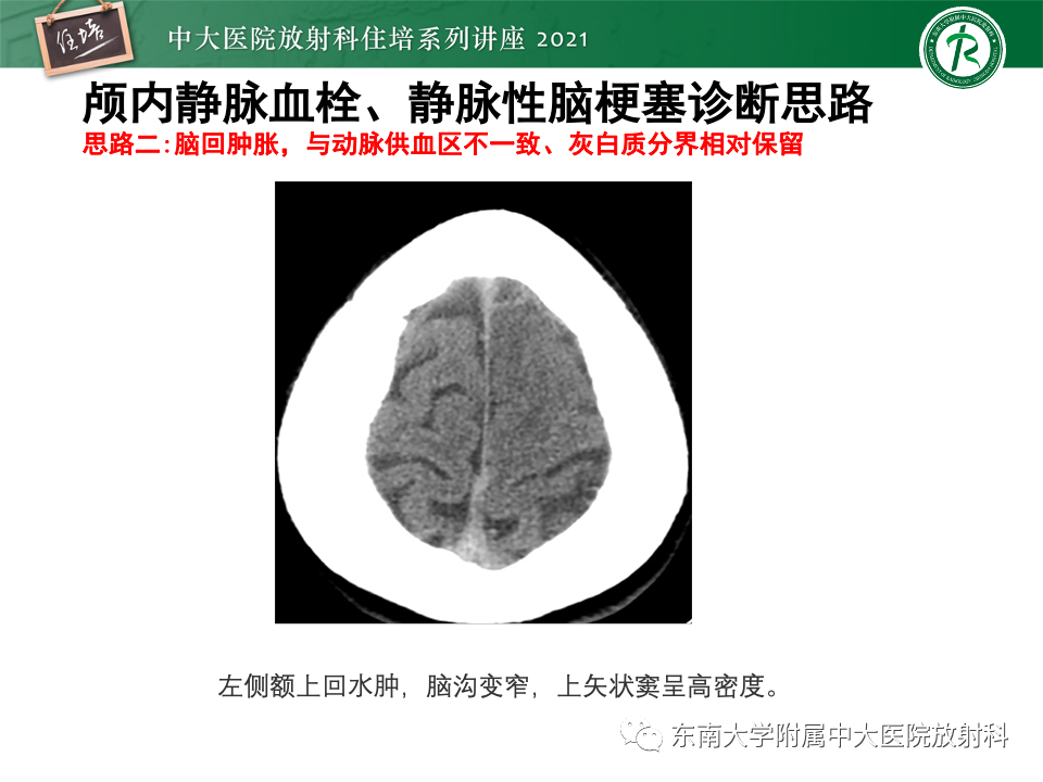 影像PPT - 【PPT】静脉性脑梗死的诊断思路-36