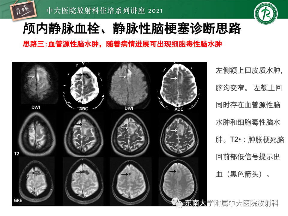 影像PPT - 【PPT】静脉性脑梗死的诊断思路-37