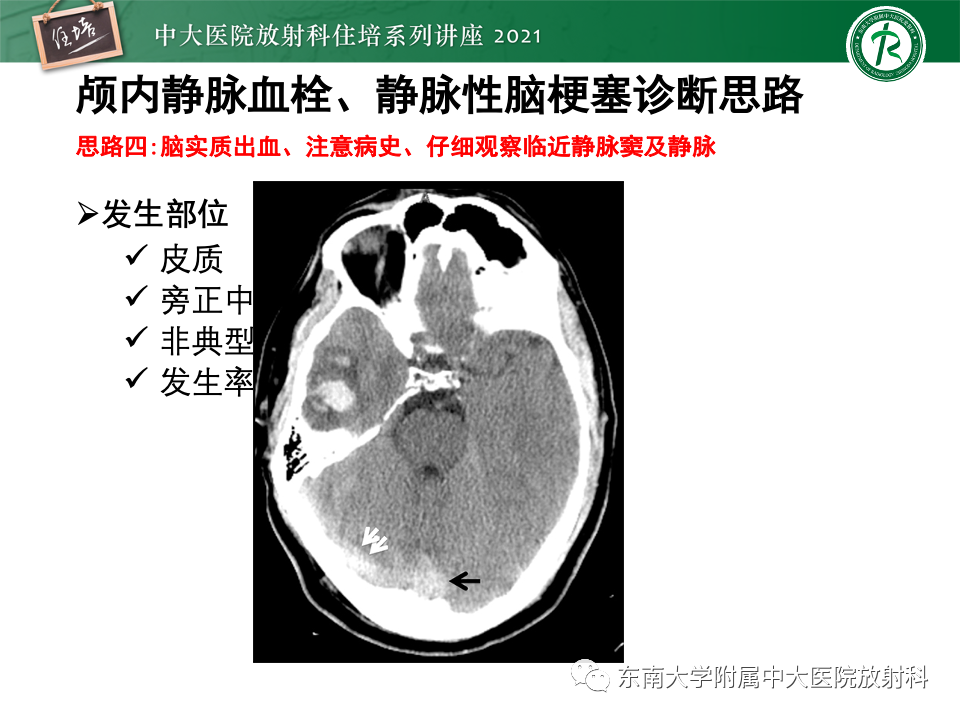 影像PPT - 【PPT】静脉性脑梗死的诊断思路-38