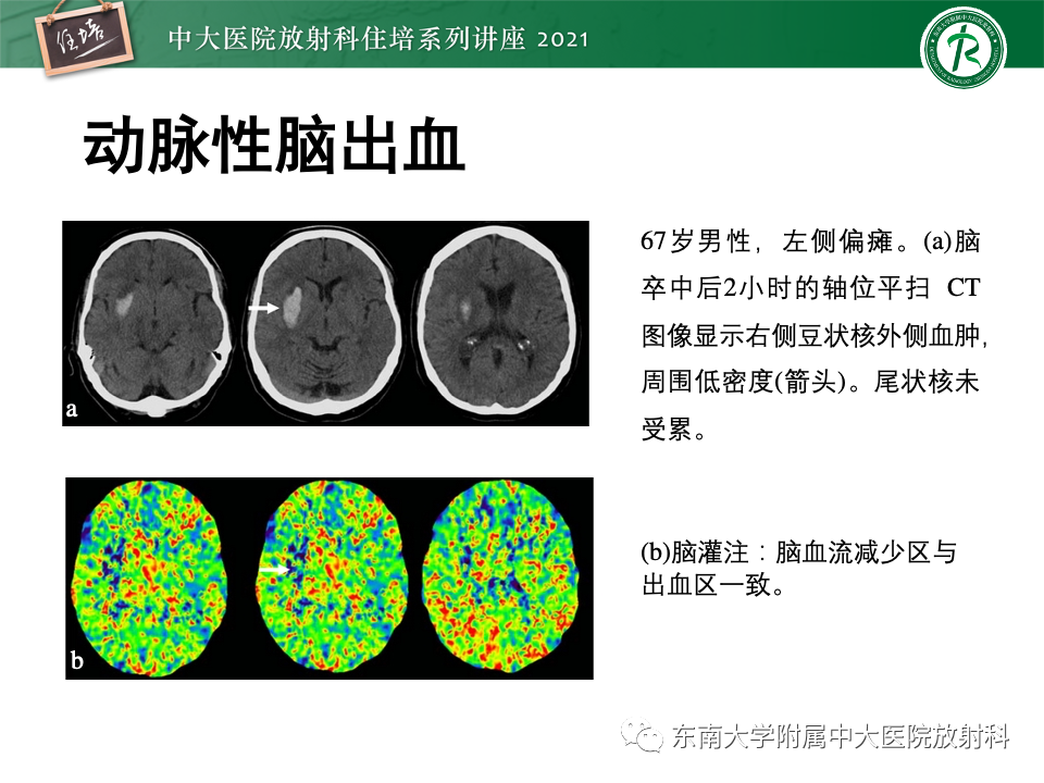 影像PPT - 【PPT】静脉性脑梗死的诊断思路-40
