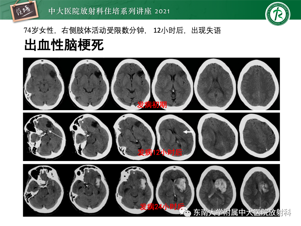 影像PPT - 【PPT】静脉性脑梗死的诊断思路-41