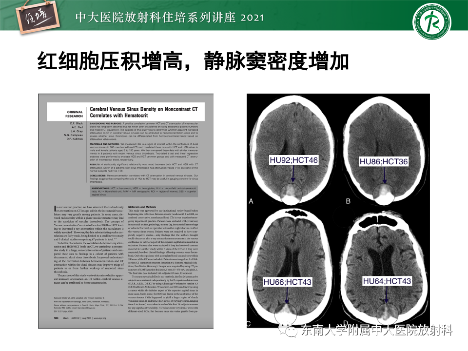 影像PPT - 【PPT】静脉性脑梗死的诊断思路-43