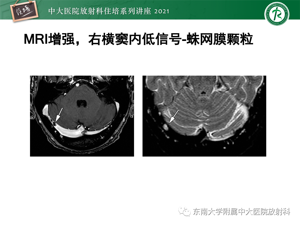 影像PPT - 【PPT】静脉性脑梗死的诊断思路-44