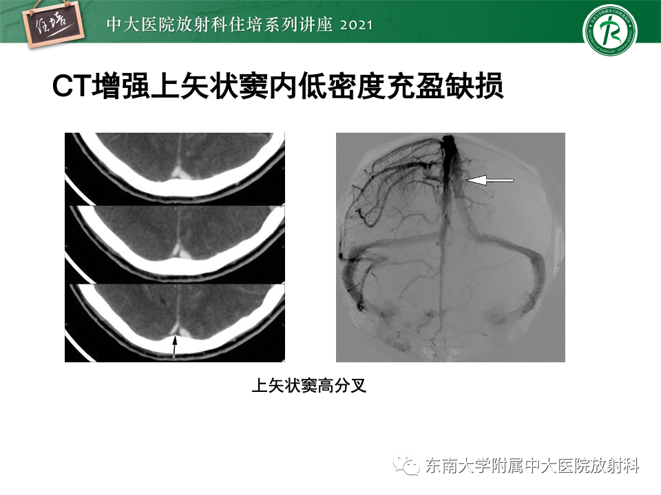 影像PPT - 【PPT】静脉性脑梗死的诊断思路-45
