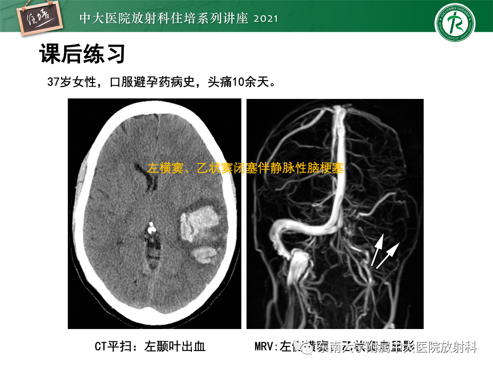 影像PPT - 【PPT】静脉性脑梗死的诊断思路-47