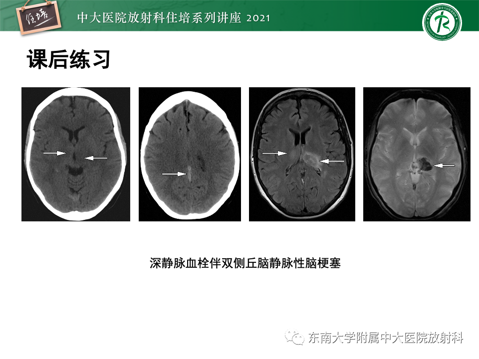 影像PPT - 【PPT】静脉性脑梗死的诊断思路-48