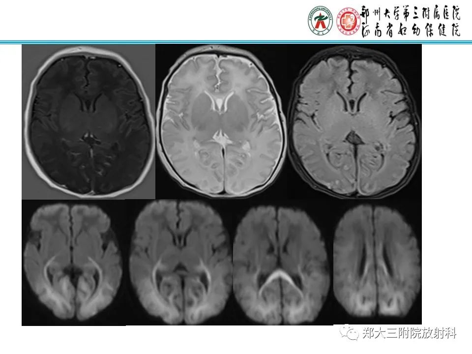 影像PPT - 【PPT】新生儿低血糖脑病-13