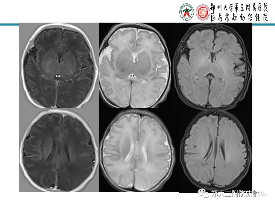 影像PPT - 【PPT】新生儿低血糖脑病-15