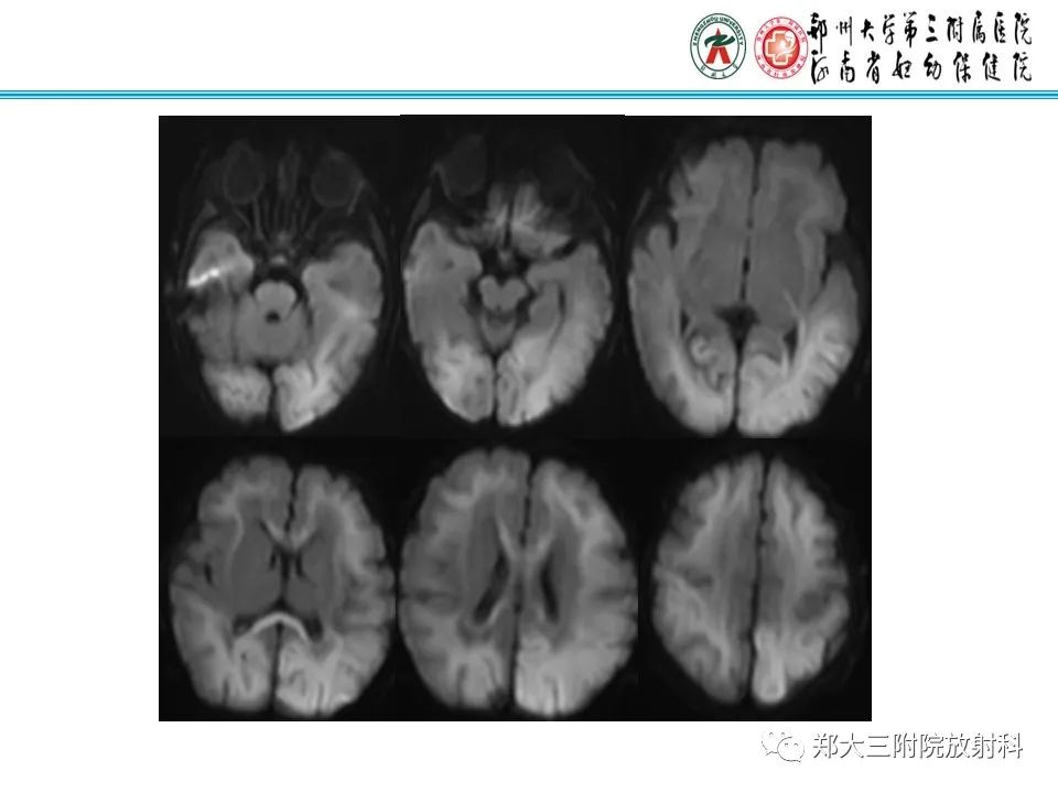影像PPT - 【PPT】新生儿低血糖脑病-16