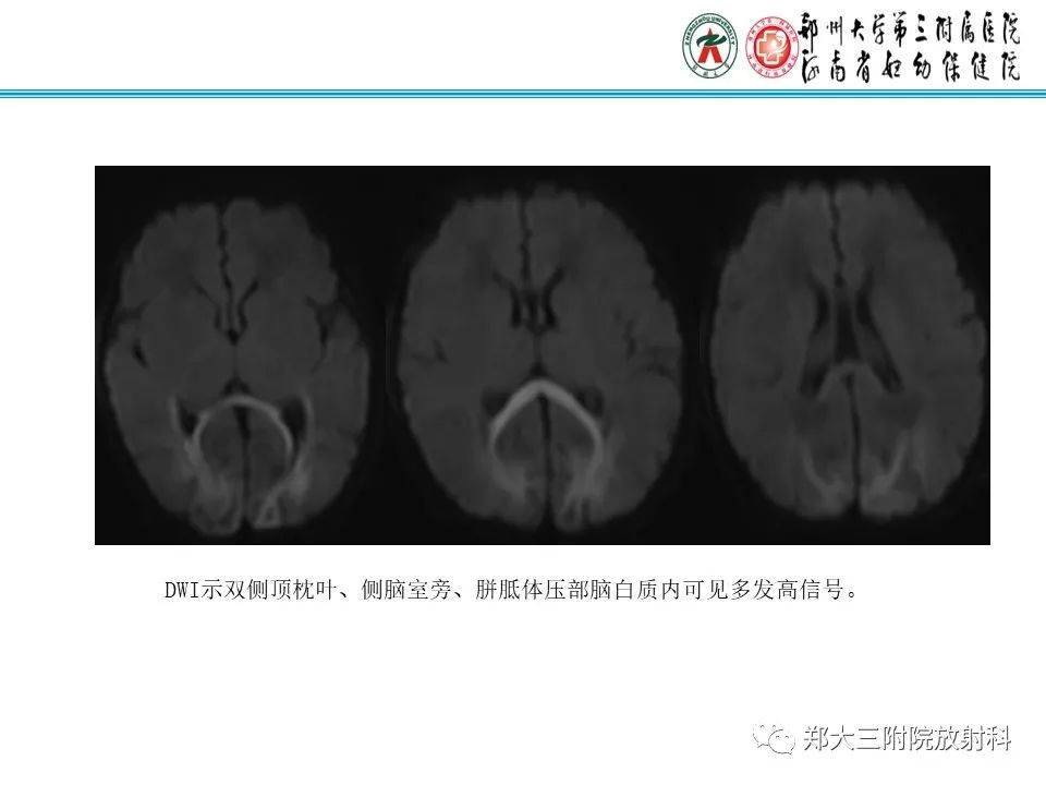 影像PPT - 【PPT】新生儿低血糖脑病-18