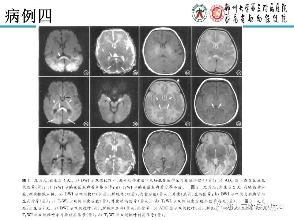 影像PPT - 【PPT】新生儿低血糖脑病-19