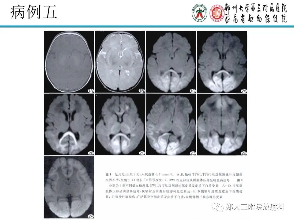 影像PPT - 【PPT】新生儿低血糖脑病-20