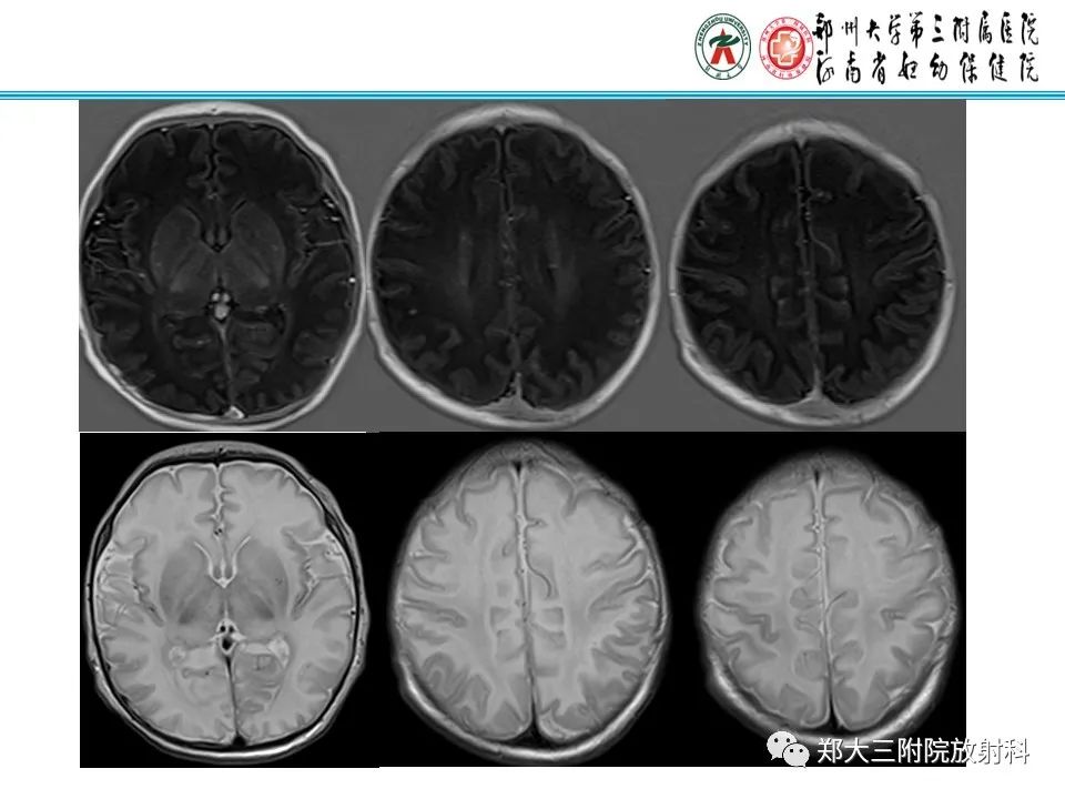 影像PPT - 【PPT】新生儿低血糖脑病-23