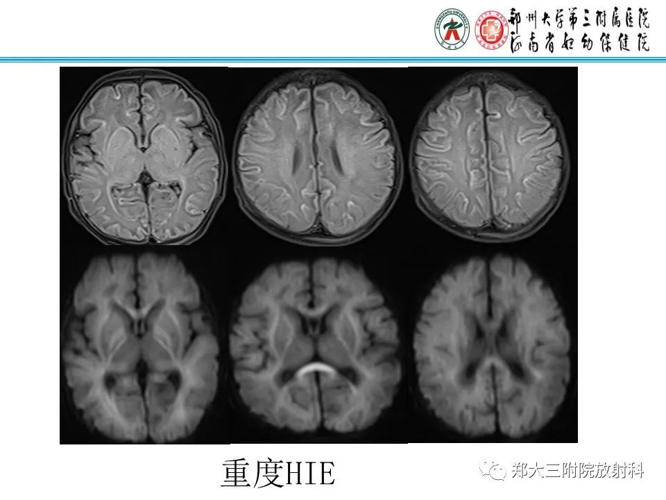影像PPT - 【PPT】新生儿低血糖脑病-24