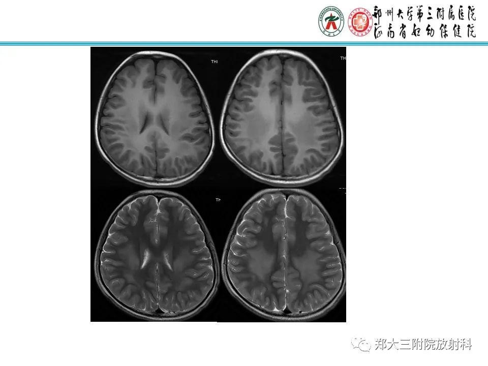 影像PPT - 【PPT】新生儿低血糖脑病-29