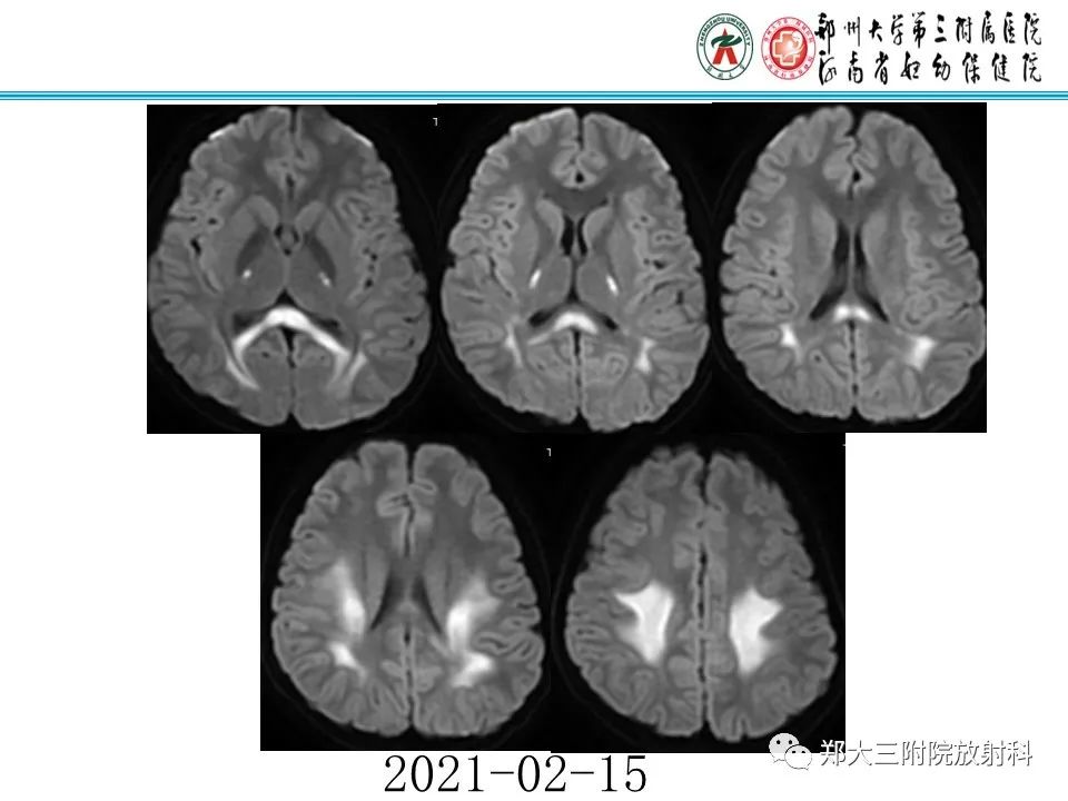 影像PPT - 【PPT】新生儿低血糖脑病-30