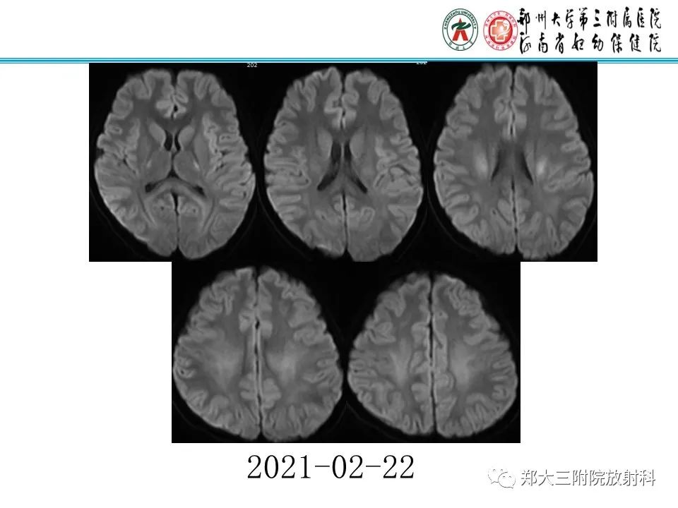 影像PPT - 【PPT】新生儿低血糖脑病-31