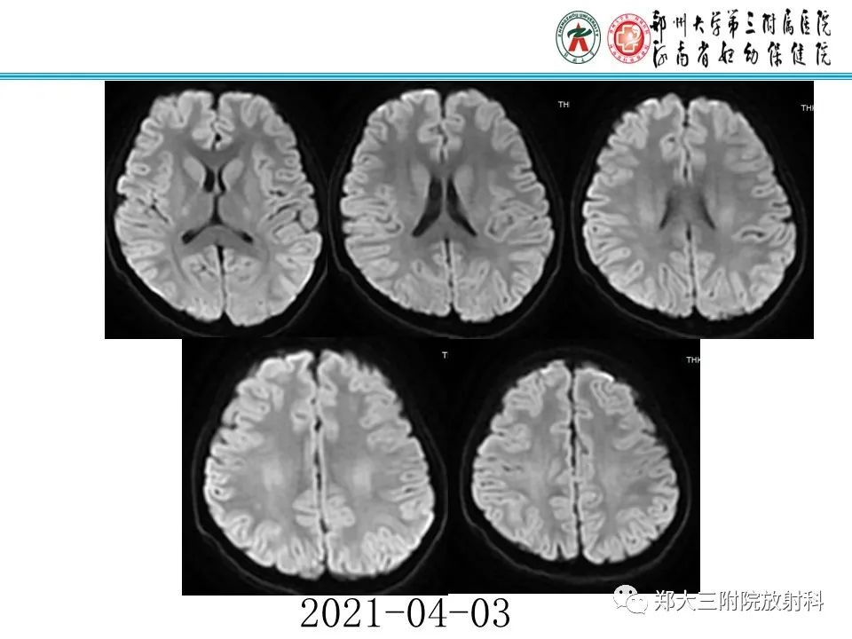 影像PPT - 【PPT】新生儿低血糖脑病-32