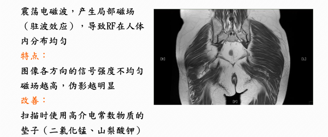 影像PPT - 这20个MRI伪影,你了解了吗?-30 影像PPT - 这20个MRI伪影,你了解了吗?-30